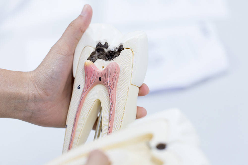 درمان ریشه دندان پوسیده با متخصص ایندو صفورا امامی 6